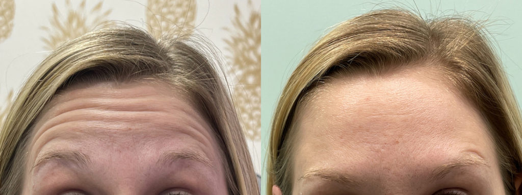 before and after photo set of forehead wrinkle treatment as a benefit of Botox