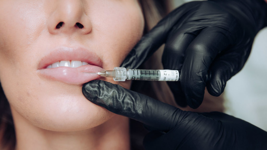 woman receiving dermal filler injection for lips