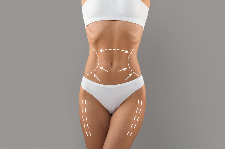 A woman's body with dotted lines indicating areas for potential liposuction.