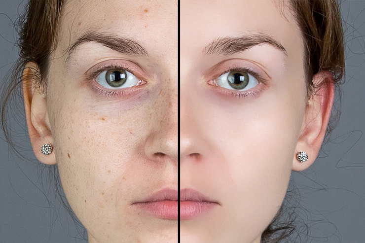 Before and after comparison of a woman's face, showing clear improvement in skin tone and texture.