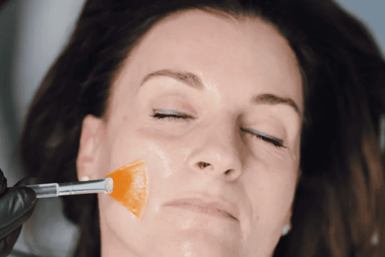 Chemical Peels
